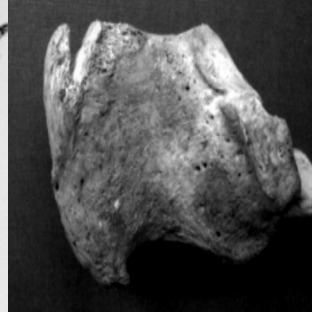 virmuze exhibit Enthesophytosis of the bones of the lower extremities logo main